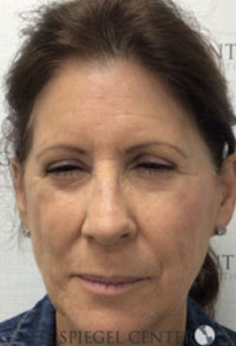 Botox / Dysport / Jeuveau / Xeomin Before & After Gallery - Patient 157140460 - Image 1