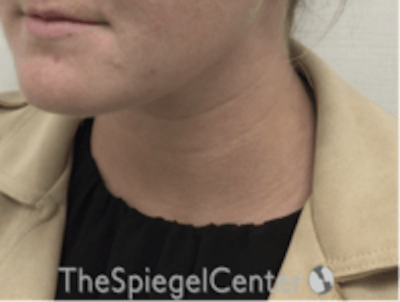 Facetite / Necktite / Embrace Before & After Gallery - Patient 157140456 - Image 4