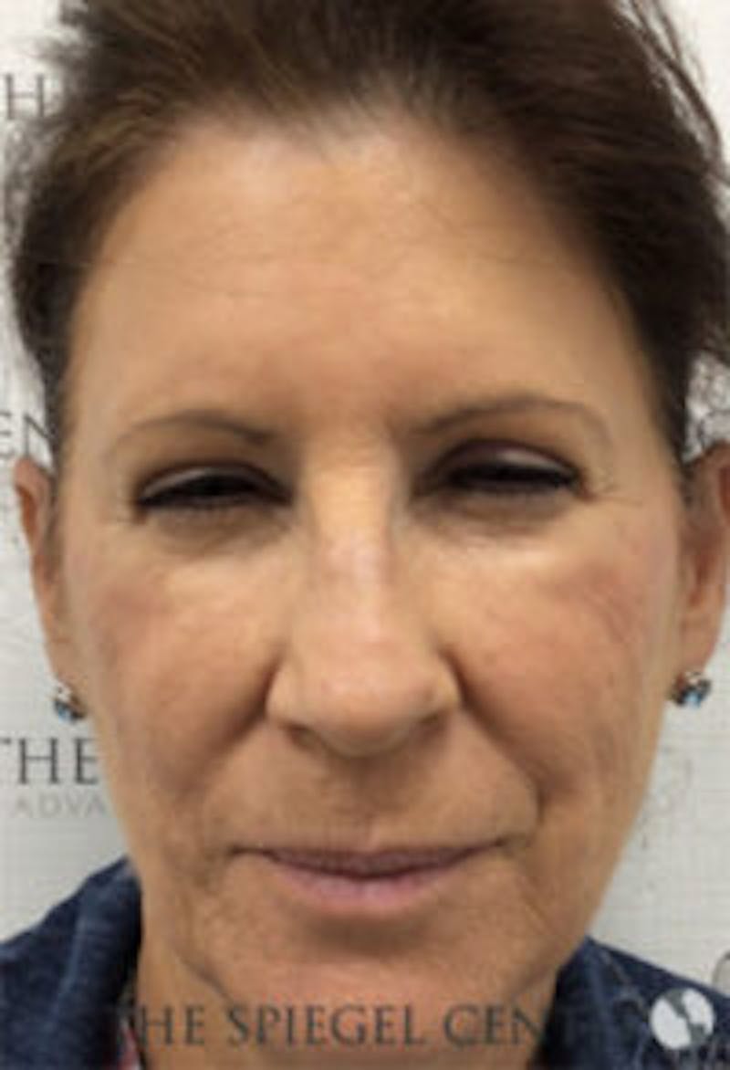 Botox / Dysport / Jeuveau / Xeomin Before & After Gallery - Patient 157140460 - Image 2