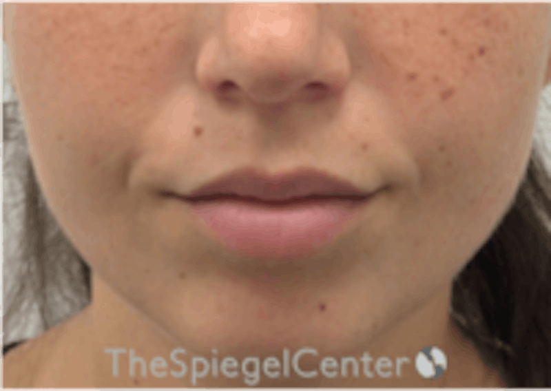 Lip Filler Before & After Gallery - Patient 157140463 - Image 3