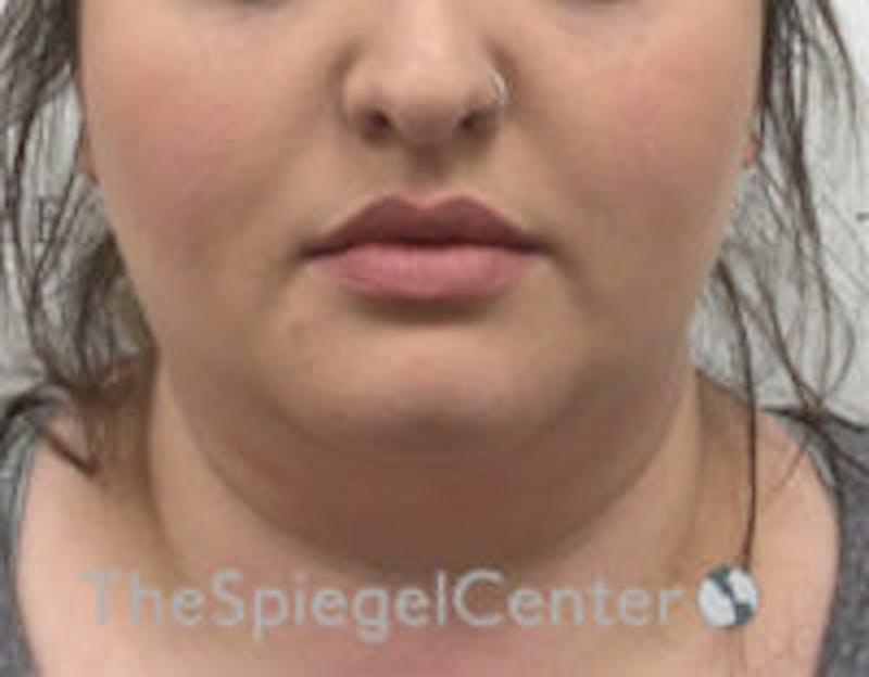 Masseter Botox Before & After Gallery - Patient 157140461 - Image 2