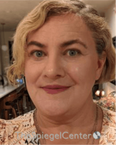 FFS Before & After Gallery - Patient 157140457 - Image 4