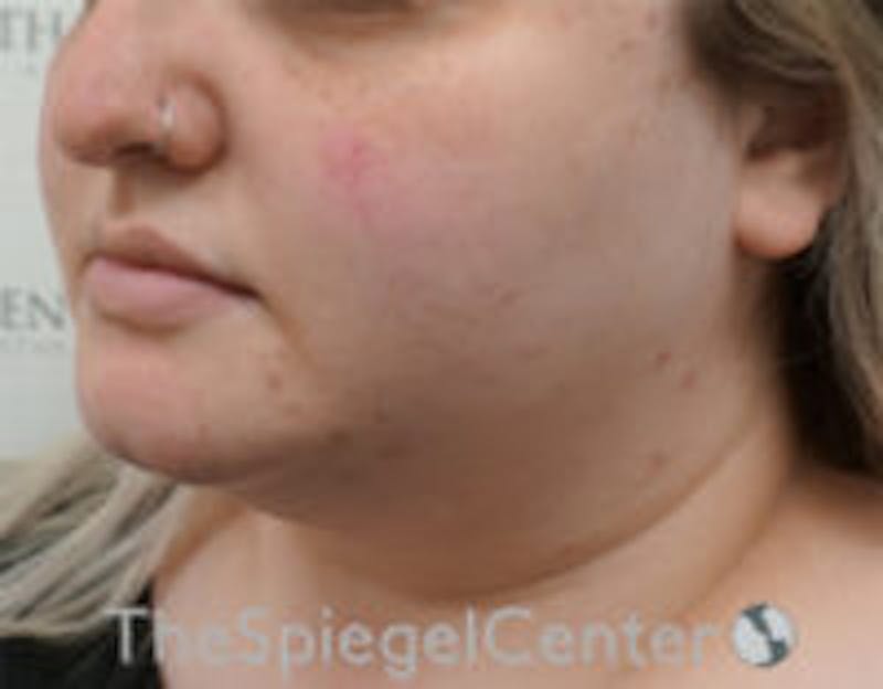 Masseter Botox Before & After Gallery - Patient 157140461 - Image 3