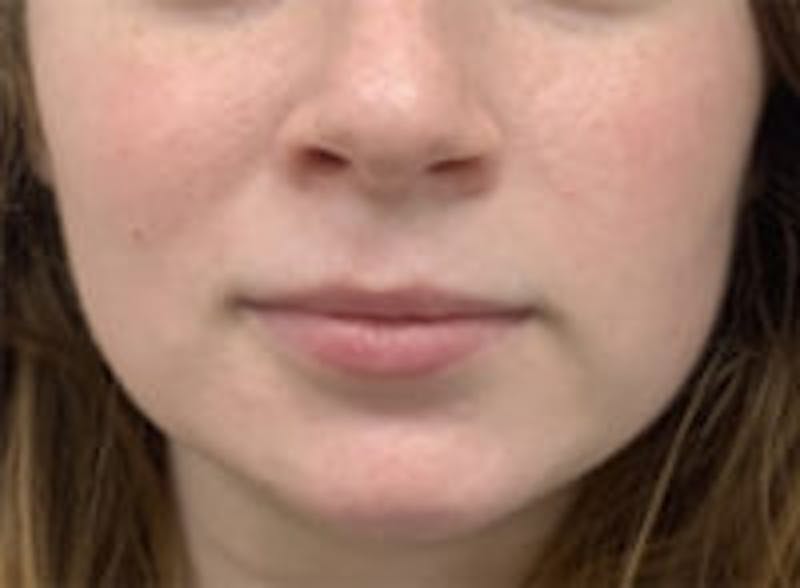 Mandible Jaw Filler Before & After Gallery - Patient 157140462 - Image 2