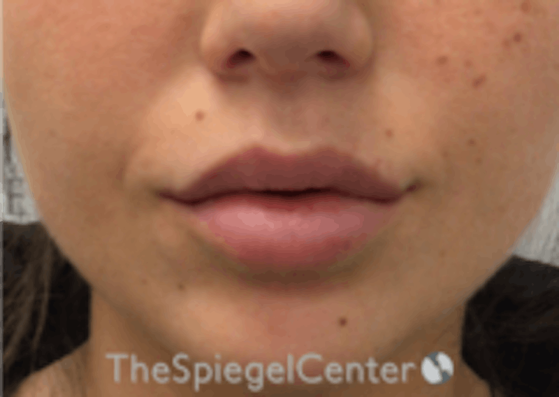 Lip Filler Before & After Gallery - Patient 157140463 - Image 4