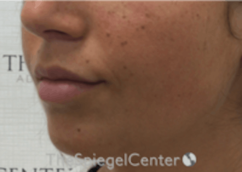 Lip Filler Before & After Gallery - Patient 157140463 - Image 5