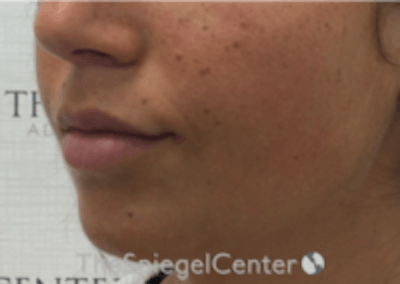 Lip Filler Before & After Gallery - Patient 157140463 - Image 5