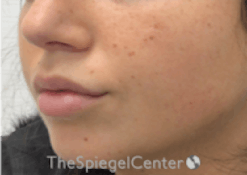 Lip Filler Before & After Gallery - Patient 157140463 - Image 6