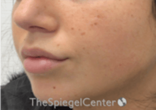 Lip Filler Before & After Gallery - Patient 157140463 - Image 6