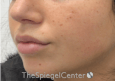 Lip Filler Before & After Gallery - Patient 157140463 - Image 6