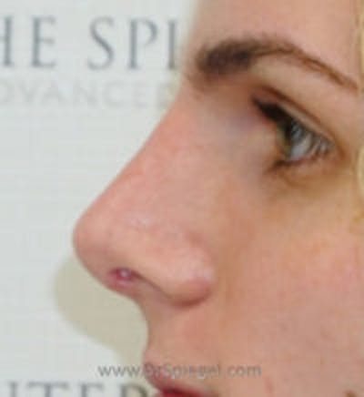 Rhinoplasty Before & After Gallery - Patient 157140464 - Image 2