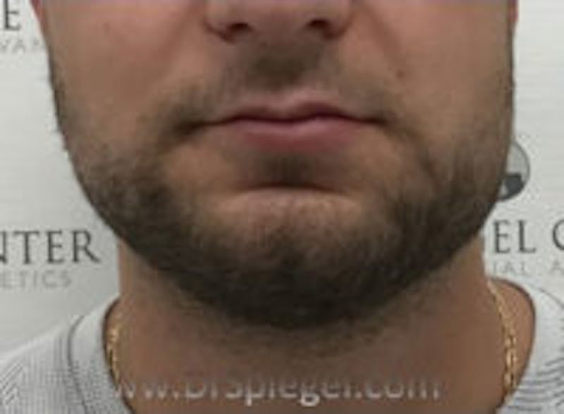 Mandible Jaw Filler Before & After Gallery - Patient 157140466 - Image 1