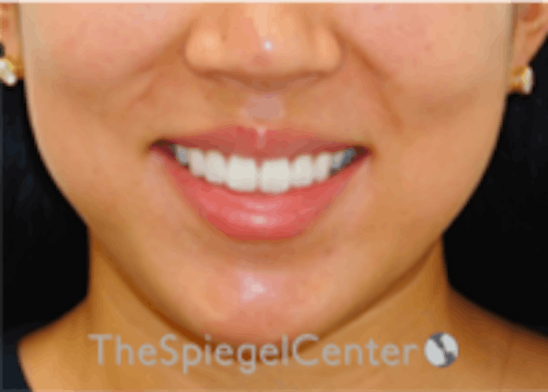 Lip Filler Before & After Gallery - Patient 157140474 - Image 1