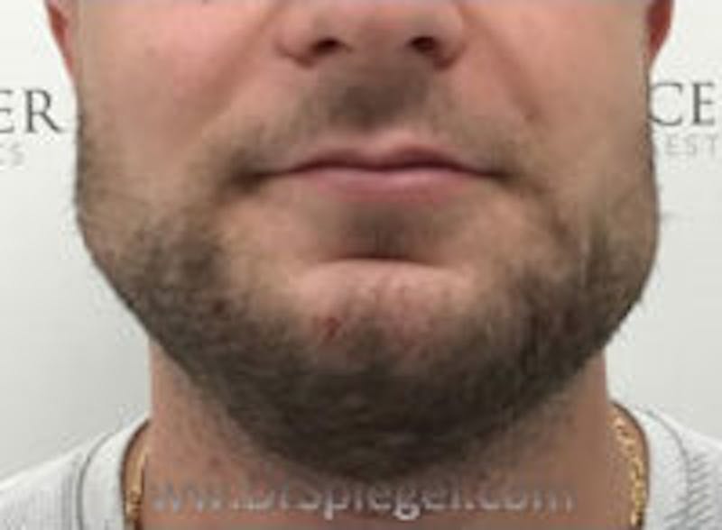 Mandible Jaw Filler Before & After Gallery - Patient 157140466 - Image 2