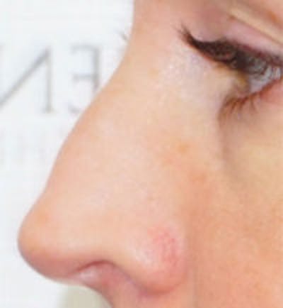 Rhinoplasty Before & After Gallery - Patient 157140468 - Image 1