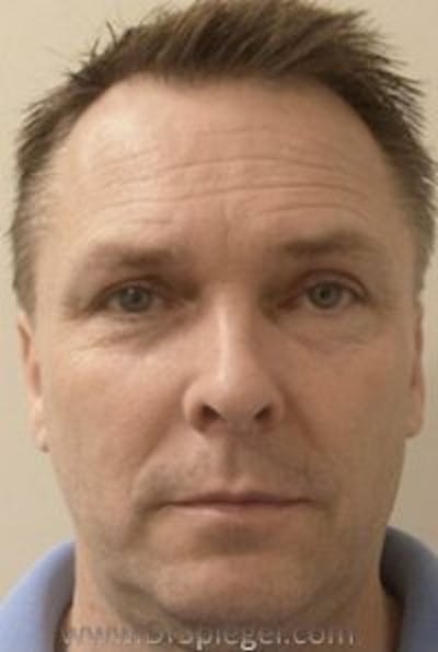 Botox / Dysport / Jeuveau / Xeomin Before & After Gallery - Patient 157140469 - Image 3