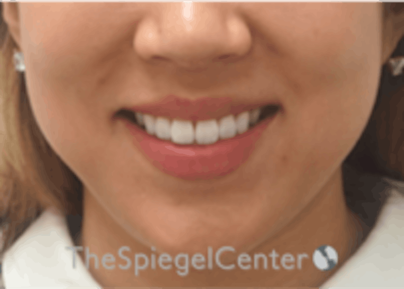 Lip Filler Before & After Gallery - Patient 157140474 - Image 2