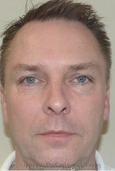 Botox / Dysport / Jeuveau / Xeomin Before & After Gallery - Patient 157140469 - Image 4