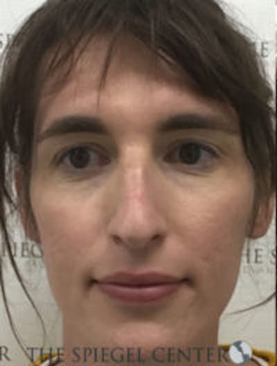 FFS Before & After Gallery - Patient 157140472 - Image 1