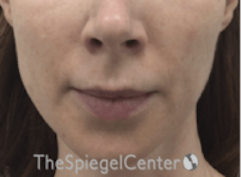 Jawline Filler
