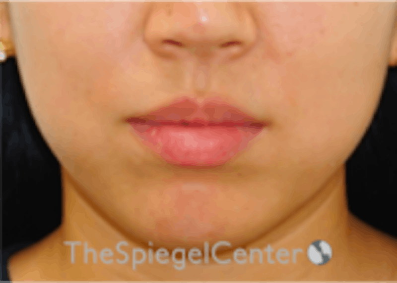 Lip Filler Before & After Gallery - Patient 157140474 - Image 3