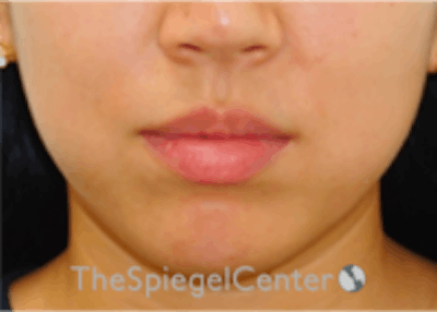 Lip Filler Before & After Gallery - Patient 157140474 - Image 3