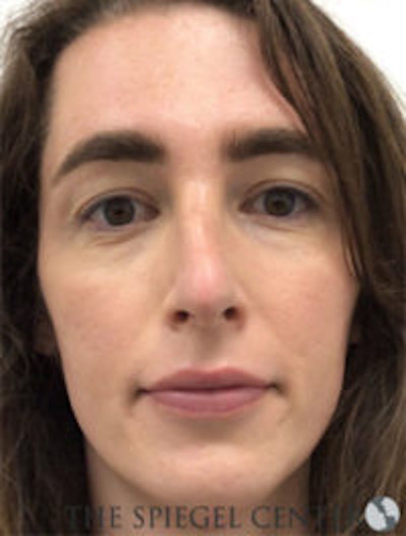 FFS Before & After Gallery - Patient 157140472 - Image 2