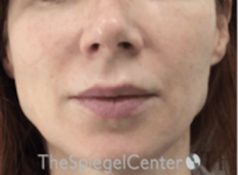 Mandible Jaw Filler Before & After Gallery - Patient 157140473 - Image 2