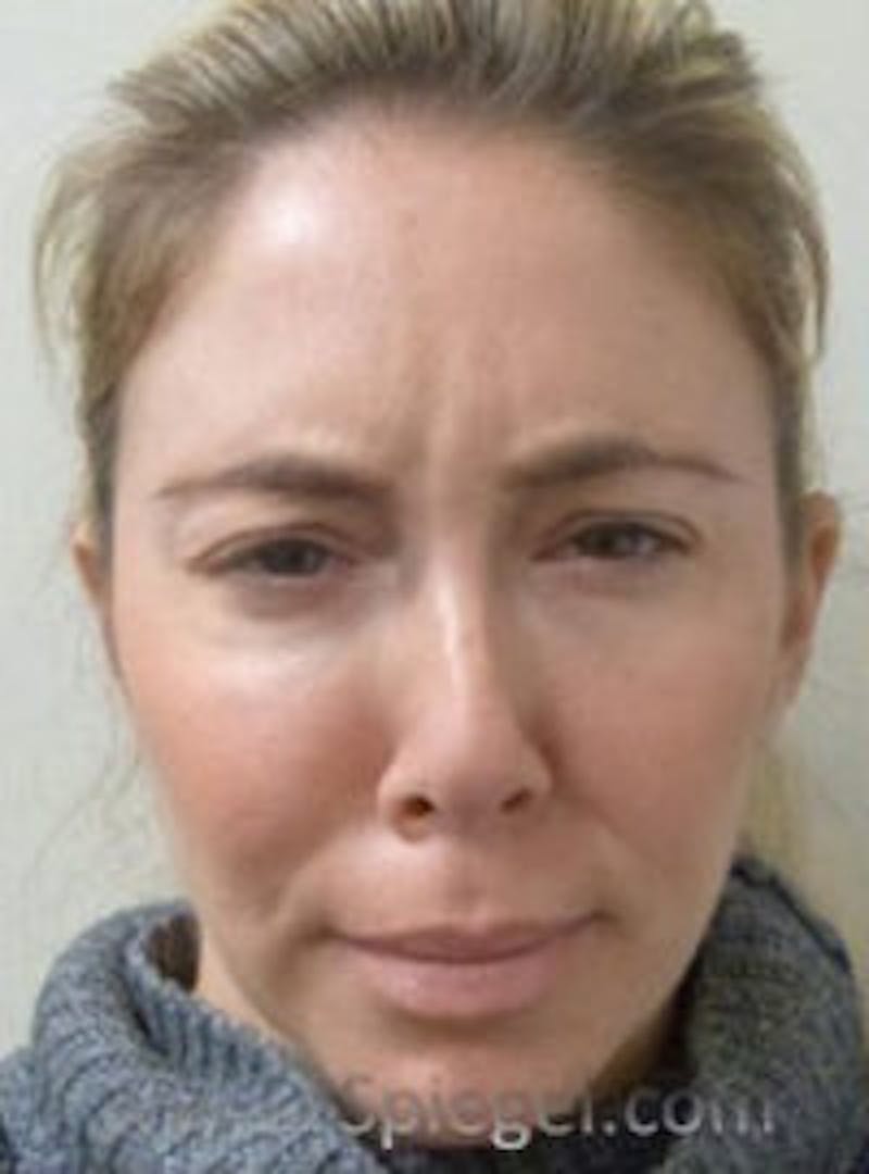 Botox / Dysport / Jeuveau / Xeomin Before & After Gallery - Patient 157140477 - Image 1