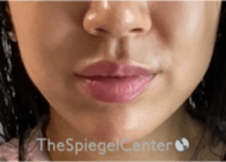 Lip Filler Before & After Gallery - Patient 157140474 - Image 4