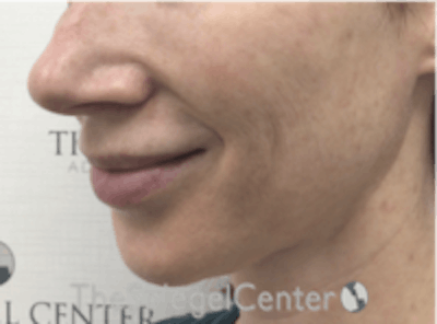 Mandible Jaw Filler Before & After Gallery - Patient 157140473 - Image 3