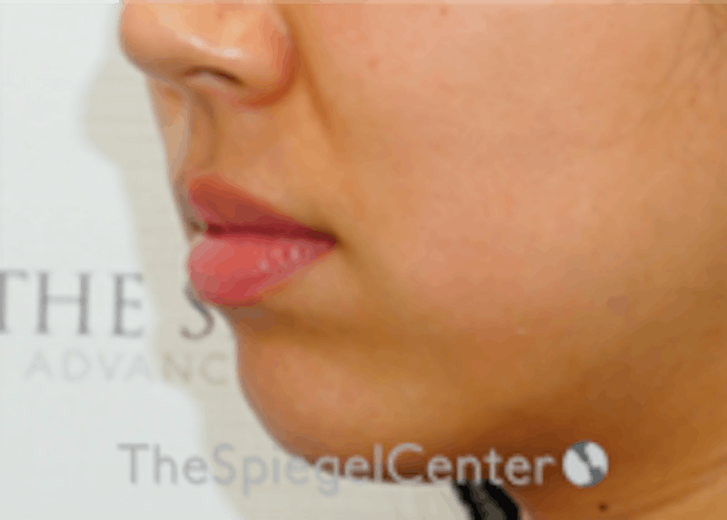 Lip Filler Before & After Gallery - Patient 157140474 - Image 5