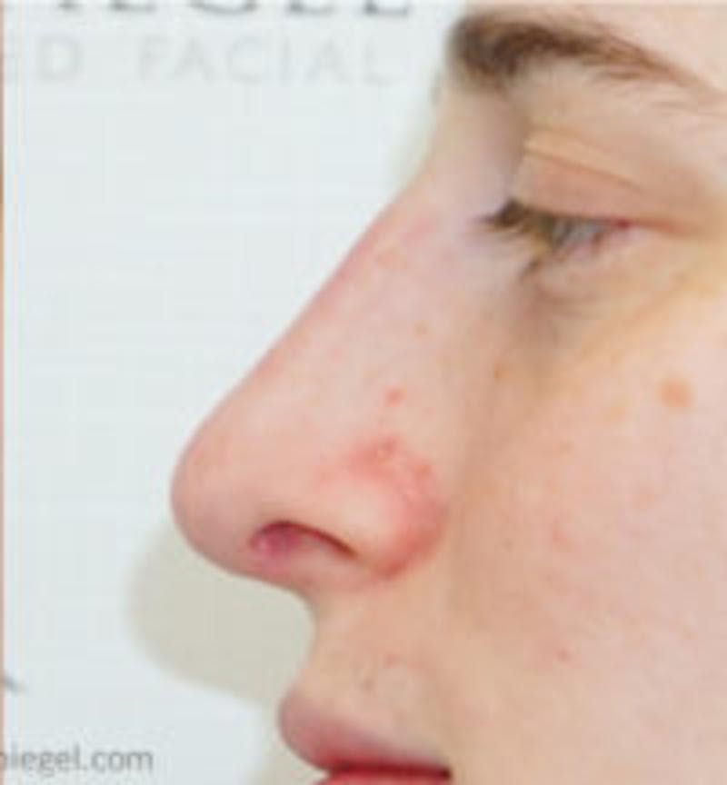 Rhinoplasty Before & After Gallery - Patient 157140471 - Image 2