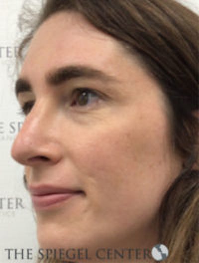 FFS Before & After Gallery - Patient 157140472 - Image 4