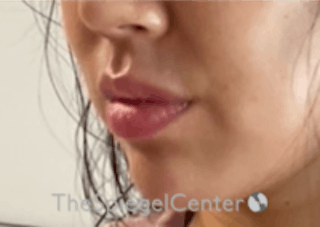 Lip Filler Before & After Gallery - Patient 157140474 - Image 6