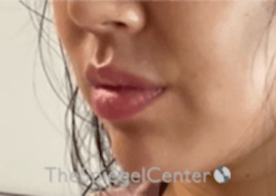 Lip Filler Before & After Gallery - Patient 157140474 - Image 6
