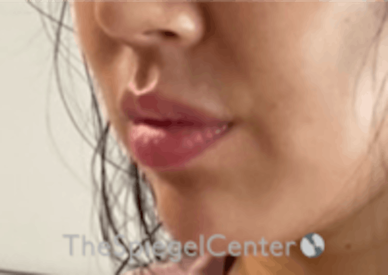 Lip Filler Before & After Gallery - Patient 157140474 - Image 6