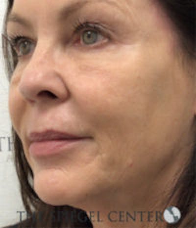 Morpheus8 Before & After Gallery - Patient 157140475 - Image 2