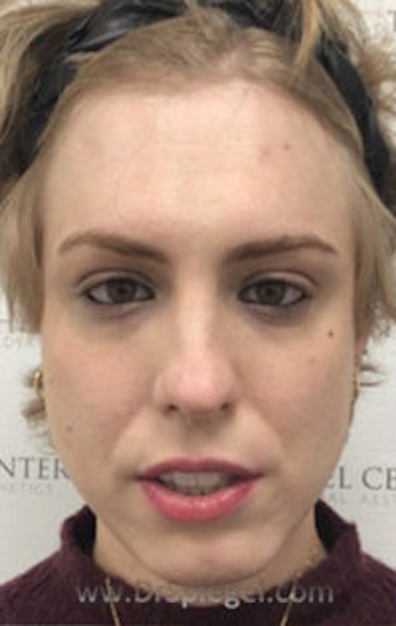 FFS Before & After Gallery - Patient 157140481 - Image 1
