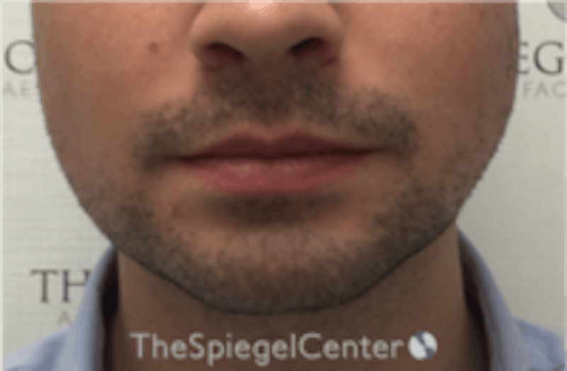 Mandible Jaw Filler Before & After Gallery - Patient 157140483 - Image 1