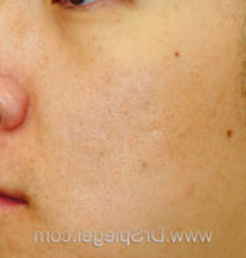 Microneedling Before & After Gallery - Patient 157140480 - Image 1