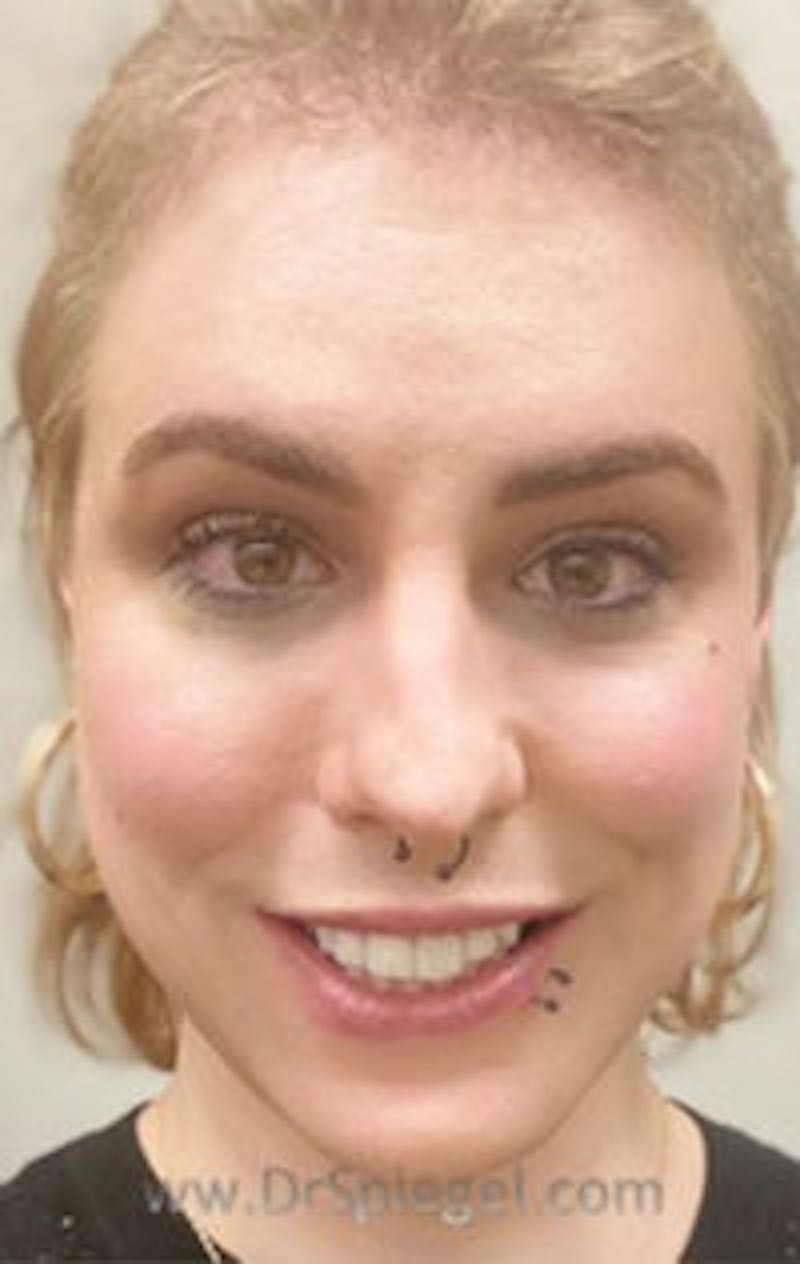 FFS Before & After Gallery - Patient 157140481 - Image 2