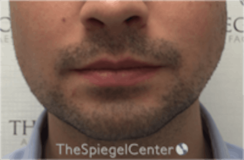 Mandible Jaw Filler Before & After Gallery - Patient 157140483 - Image 2