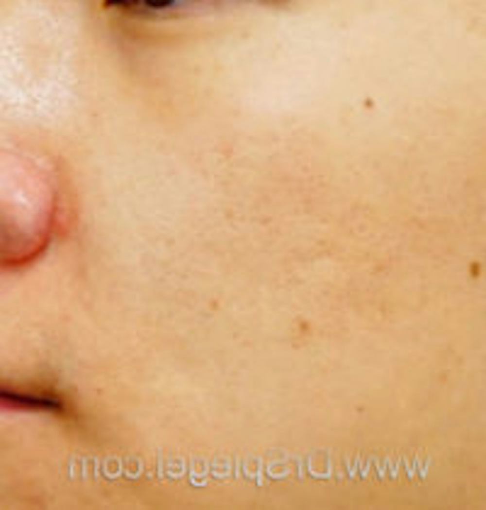 Microneedling