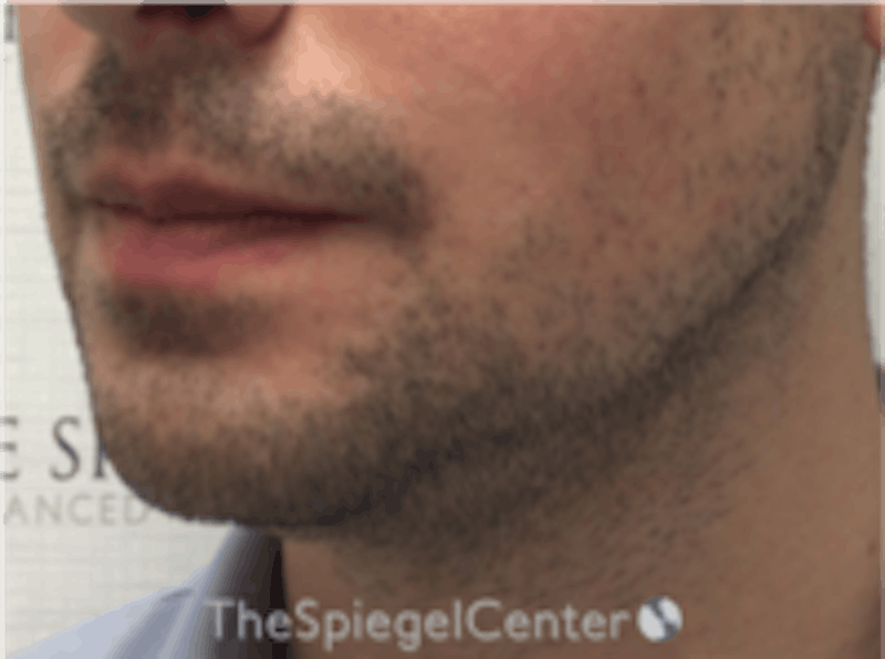 Mandible Jaw Filler Before & After Gallery - Patient 157140483 - Image 3