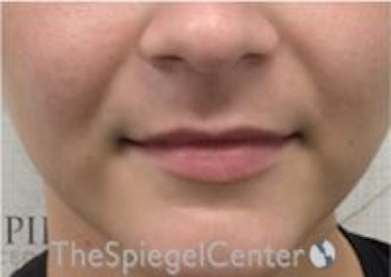 Lip Filler Before & After Gallery - Patient 157140486 - Image 3