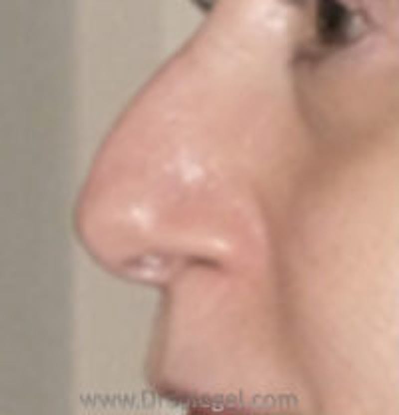 Rhinoplasty Before & After Gallery - Patient 157140482 - Image 1