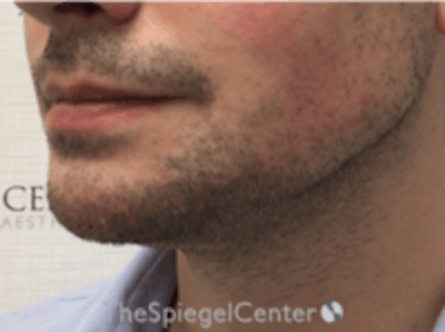 Mandible Jaw Filler Before & After Gallery - Patient 157140483 - Image 4