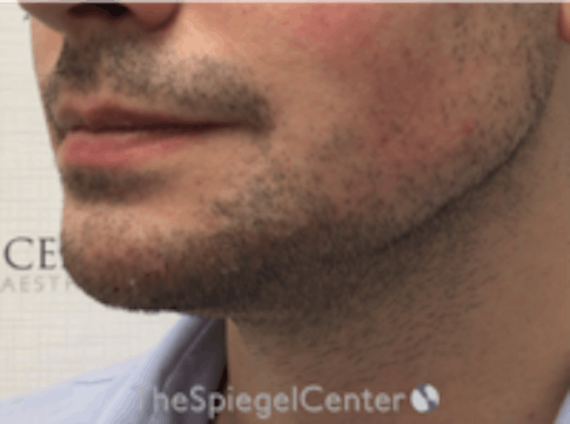 Mandible Jaw Filler Before & After Gallery - Patient 157140483 - Image 4
