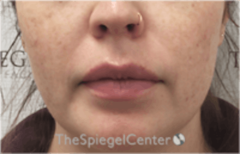 Nasolabial Fold Filler Before & After Gallery - Patient 157140489 - Image 1